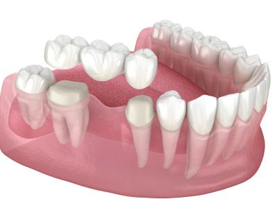 Dental Bridges